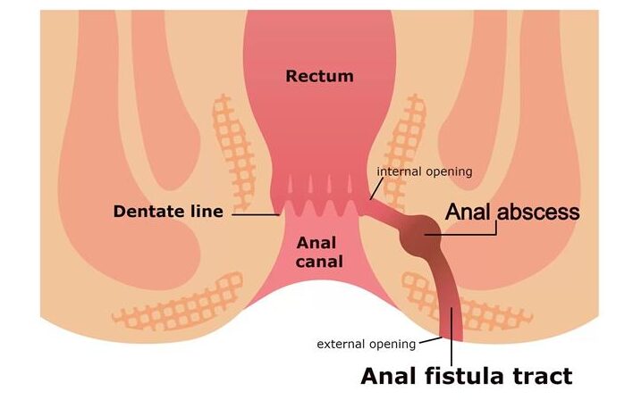 What is Anal Fistula_1